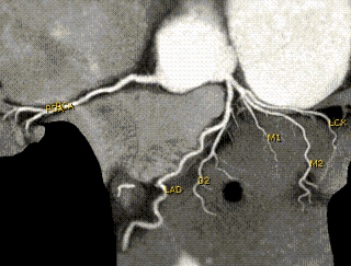 Picture of heart arteries obtained with a multislice CT scanner